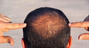 Hair Growth for Men